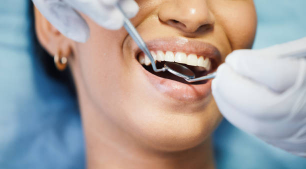 Best Root Canal Emergency Dentist  in Mccla, AL